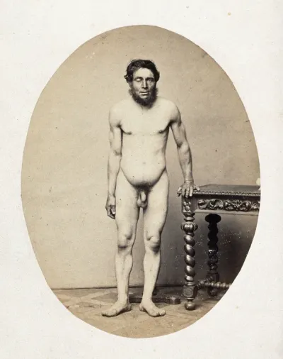 A naked man, standing, viewed in full length from the front; he is leaning on a table and his right eye is closed