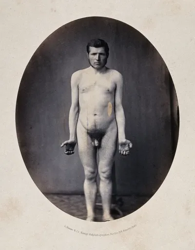A naked man viewed from the front in full-length, with semi-clenched fists