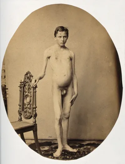 A naked young man, viewed from the front in full length; the top of his rib cage appears to be sunken