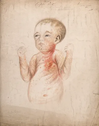 A nine week old baby girl with diseased skin on her face, arms and body, displaying symptoms of hereditary syphilis