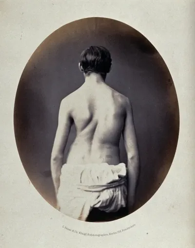 A partially clothed man, standing, viewed from behind; his spine appears severely deformed
