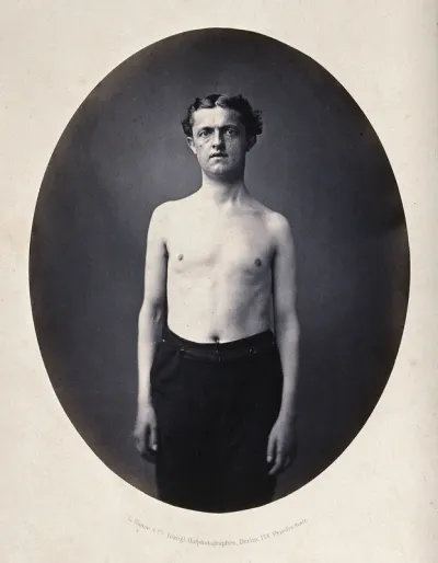 A partially clothed man, standing, viewed from the front; his left shoulder appears slightly small