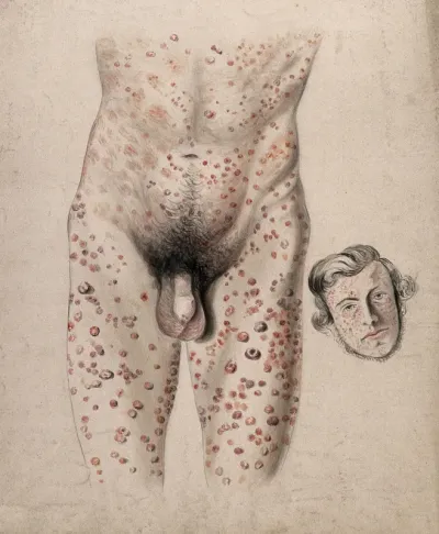 A rash of sores covering the face, legs, torso and genitals of a man: two figures, one showing the body, the other the man's face