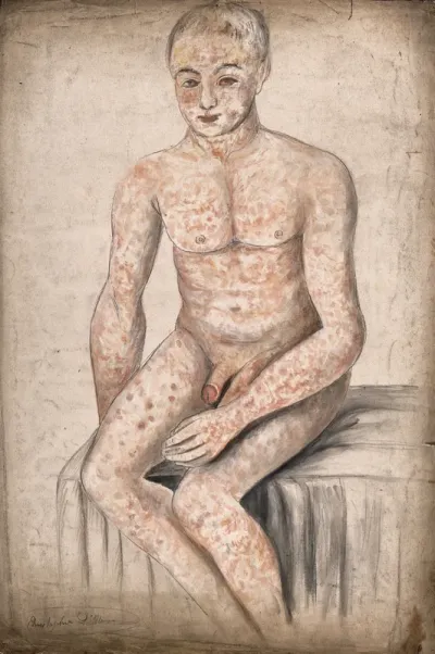 A seated man suffering from a mottled rash of sores, which covers his entire body and face