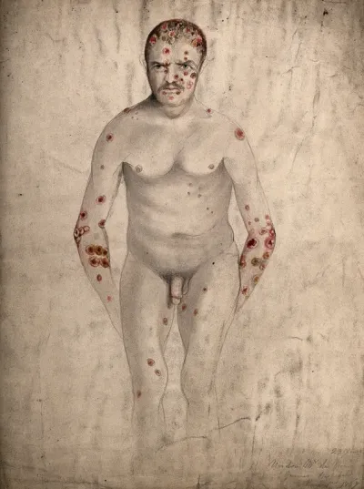 A seated man suffering from abcesses (?) and diseased areas of skin on his face, head, arms, legs and torso