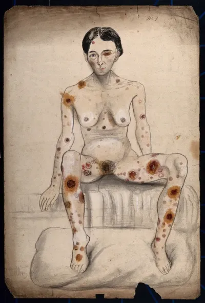 A seated woman displaying areas of diseased tissue on her entire body, face, genitals and eye