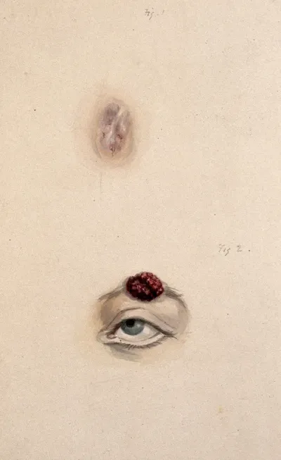 A section of a child's diseased forehead (detail); and a child's diseased eyebrow, numbered for key
