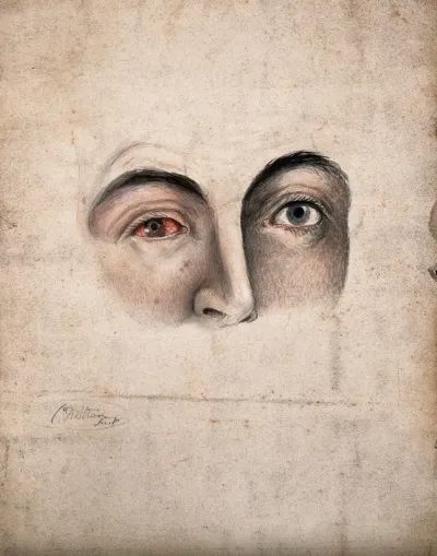 A section of a face (eyes and nose) with a disease affecting one eye