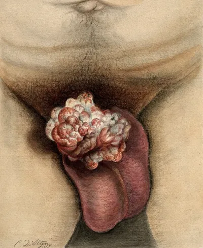 A severely diseased penis showing symptoms of carcinoma