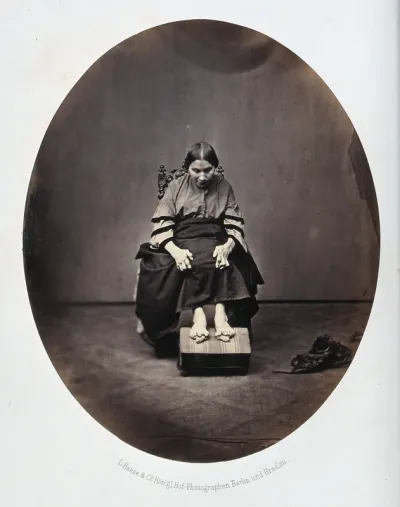 A sitting woman, her fingers and toes are severely deformed