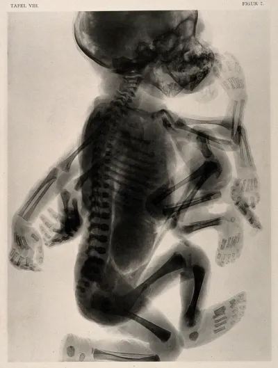 A skeleton of a child with a set of superfluous limbs and deformed head