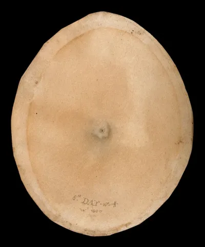A smallpox pustule on the eighth day of the disease