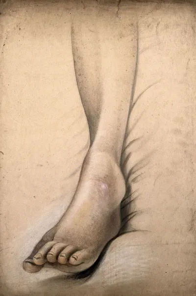 A sore with swelling on the foot of a woman