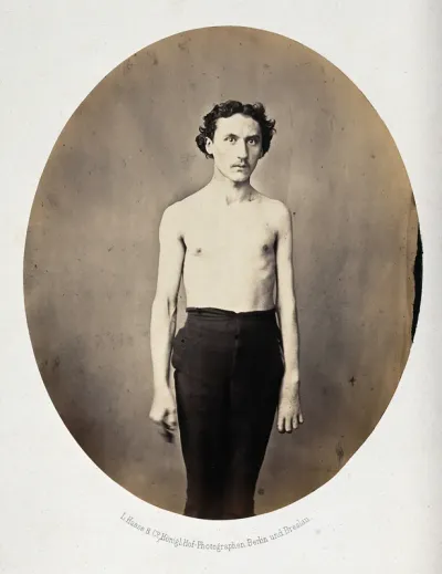 A standing man, 3/4 length view, partially clothed; his left arm appears deformed