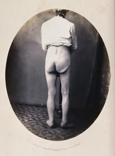 A standing man, naked from the waist down and viewed from behind; his right leg and buttock appear deformed