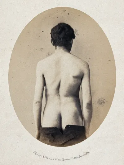 A standing man, viewed from the back with naked torso and buttocks; an imbalance in the shoulders and a curvature of the spine is evident
