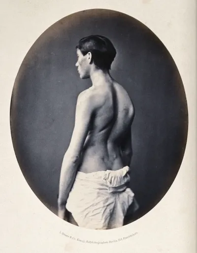 A standing young man, 3/4 length view, partially clothed; showing a deformity of the right shoulder blade