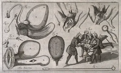 A surgeon performing a lithotomy on a patient who is being restrained by three assistants, with five other anatomical illustrations