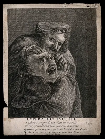 A surgeon removing moles from a grimacing patient's head