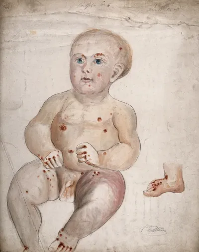 A three month old baby boy with diseased skin and sores on his face and body, with a detail showing the right foot