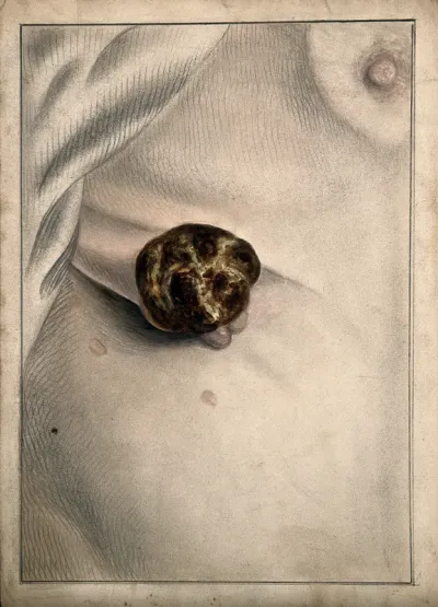 A tumour on the torso of a young woman