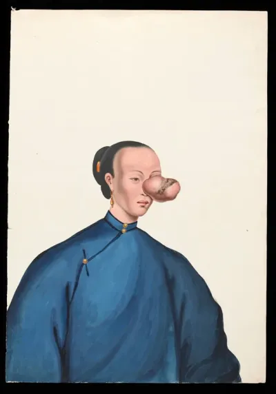 A woman, facing to right, with a large tumour covering her left eye