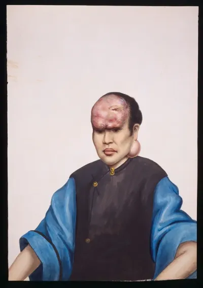 A woman (Le Sanying) with tumours on her forehead and under her left ear