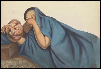 A woman (Leang Yen?) with a large tumour on her right hand, reclining and concealing her face