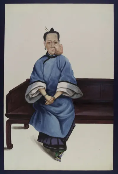 A woman (Lo Wanshun) with a tumour on her left cheek
