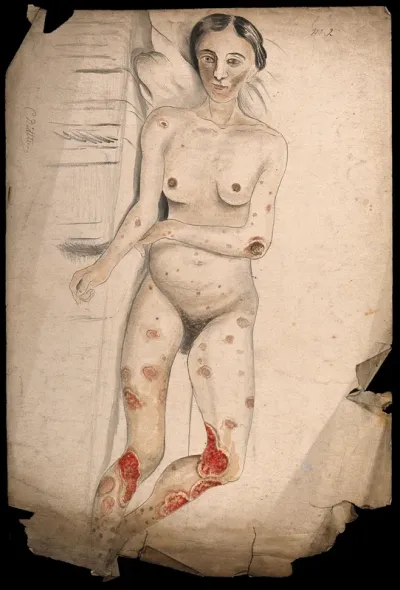 A woman lying on her side, displaying diseased areas of tissue on her arms, legs and body