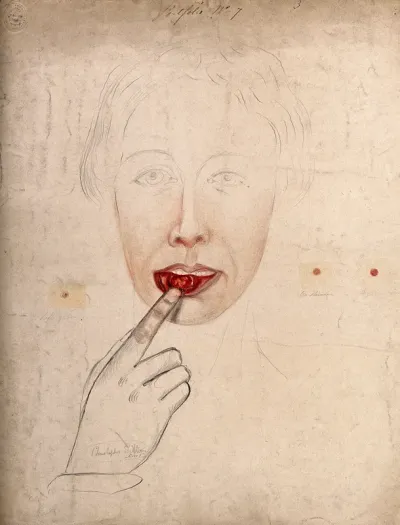 A woman pointing to a sore or abcess inside her lower lip (possibly chancre of the lip), with details showing sores found on other parts of her body
