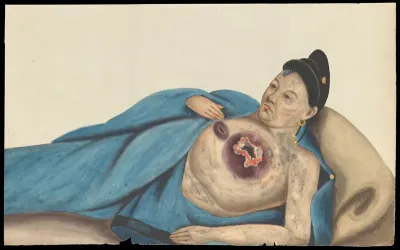 A woman, reclining, with a large tumour on her left breast