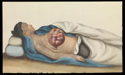 A woman, reclining, with a large tumour on her right breast