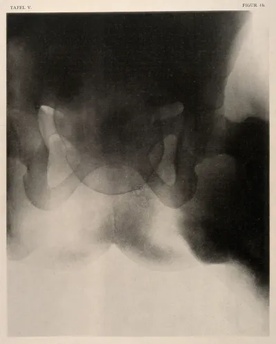 A woman's narrow pelvis with child's head stuck in the middle of a labour