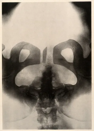 A woman's pelvis after a pubiotomy - to widen the birth canal for a vaginal delivery of a baby