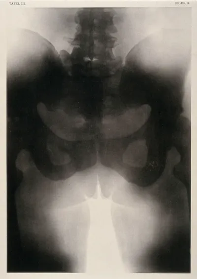 A woman's pelvis after a succesful pubiotomy - a surgical incision of the symphysis pubis generally to widen the birth canal for vaginal delivery
