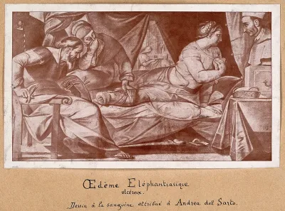 A woman suffering from elephantiasis, being examined by three people