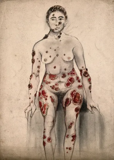 A woman suffering from open sores and abcesses on her face and entire body