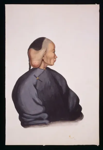 A woman with a pendent tumour over her right ear