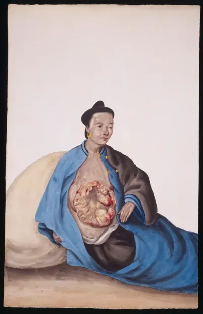 A woman with a tumour in her right breast which is expanding over her trunk