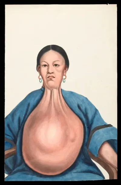 A woman (Yang She), facing front, with a massive pendent tumour hanging down from her neck