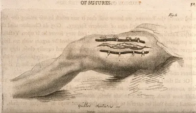 A wounded leg with a quilled suture