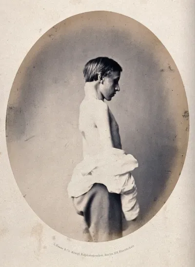 A young man, naked to the waist and viewed from the side; he has a swelling on the back of his neck