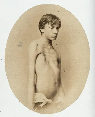 A young man, standing, unclothed to the waist; his chest is deformed
