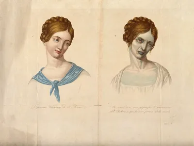 A young woman of Vienna who died of cholera, depicted when healthy and four hours before death