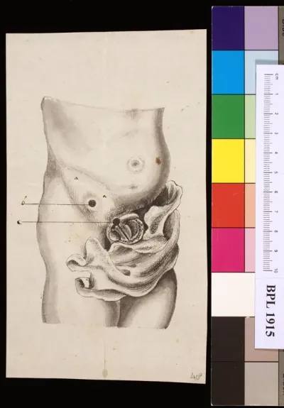 Abdominal tumor
