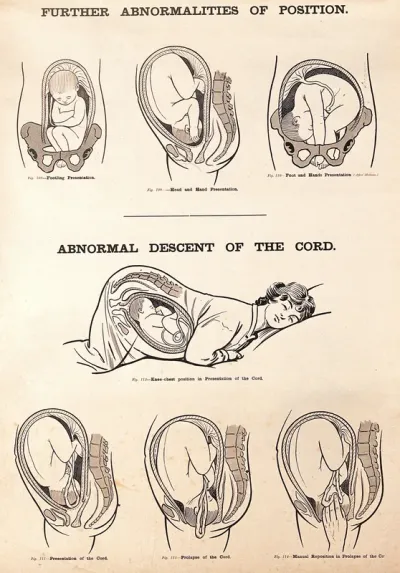 Abnormalities of foetal position and abnormal descent of the cord in childbirth