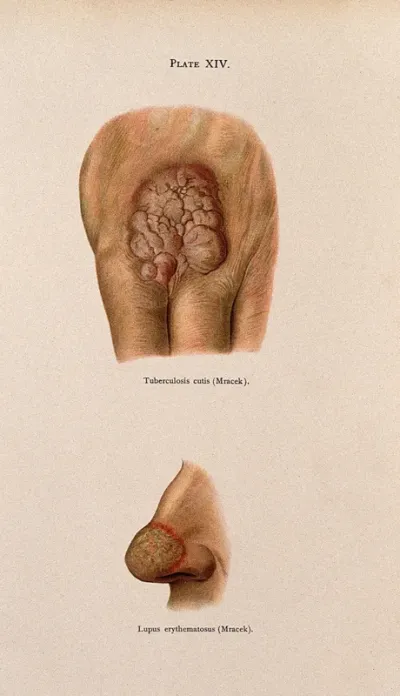 Above, eruption of tuberculosis cutis between the fingers, below, skin on the tip of the nose affected by lupus erythematosus