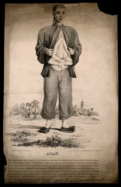 Agan, a man with headless body attached at the chest