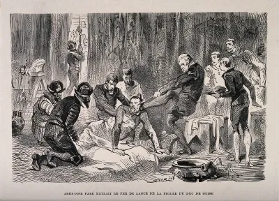 Ambroise Paré, removing the head of a spear from the face of the Duc de Guise